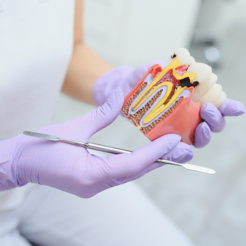 Qué es la caries y cómo prevenirla
