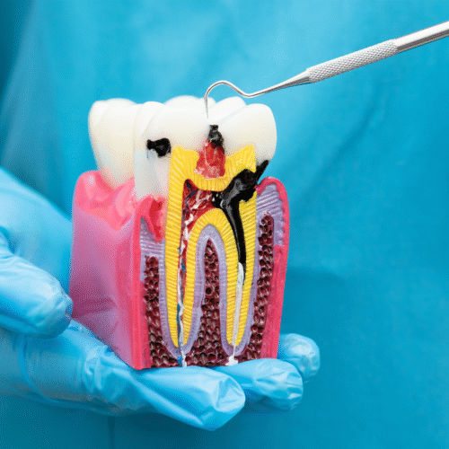 Endodoncia ¿ Qué es?