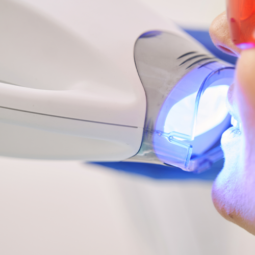 Blanqueamiento dental profesional: cómo lograr una sonrisa más blanca