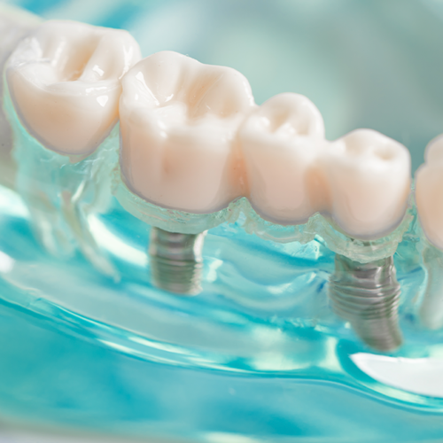 Implantes dentales: la solución para recuperar tu sonrisa