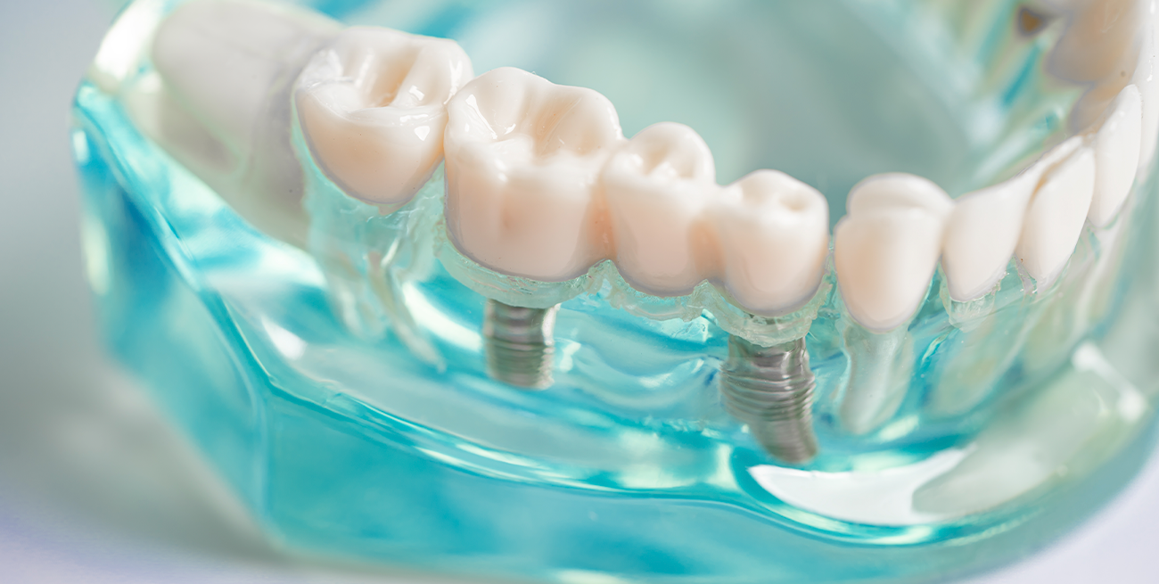 Implantes dentales: la solución para recuperar tu sonrisa